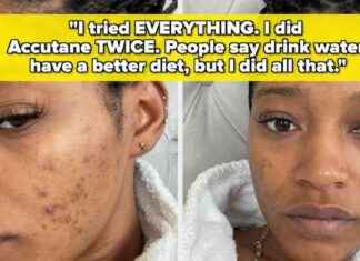 11 Berühmte Personen, die offen über ihre Akne-Probleme sprechen 11-berhmte-personen-die-offen-ber-ihre-akne-probleme-sprechen