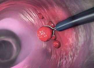 Warum Darmkrebsvorsorge wichtig ist: Neue Studie mit 11 Millionen Menschen warum-darmkrebsvorsorge-wichtig-ist-neue-studie-mit-11-millionen-menschen